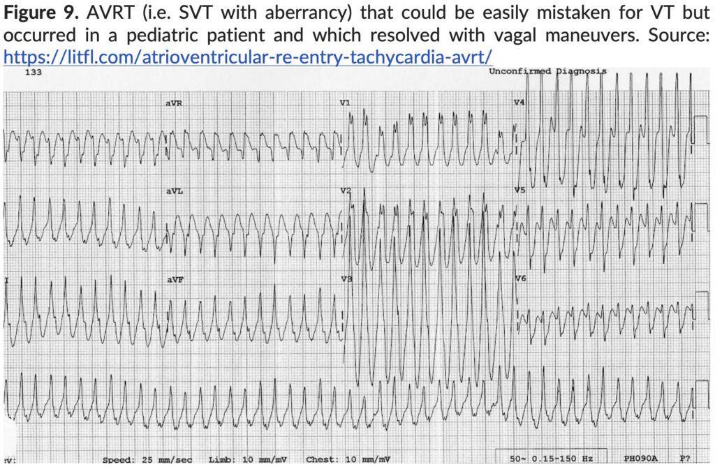 Figure 9. AVRT (i.e.) SVT with aberrancy. 